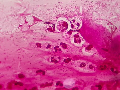 Microscopic view of Neisseria gonorrhoeae bacteria Gram stain slide. Diagnostic image showing intracellular diplococci bacteria in neutrophils for gonorrhea laboratory testing and research.
