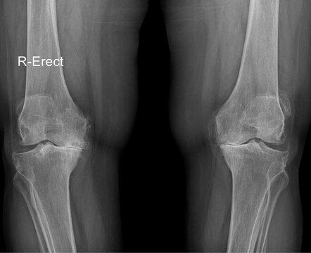 Weight-Bearing AP Bilateral Knee X-ray Demonstrating Advanced Medial Compartment Osteoarthritis