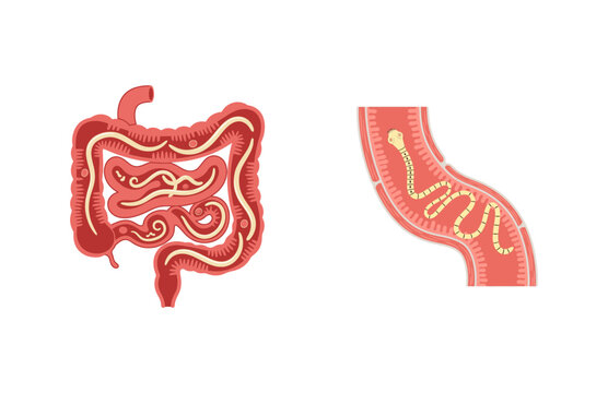 Medical Illustration of Intestinal Parasitic Worms Infestation in Human Digestive Tract