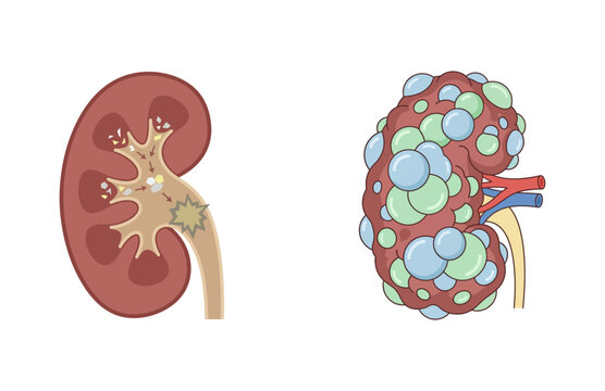 Comparison illustration of a healthy human kidney anatomy versus a diseased organ affected by polycystic kidney disease