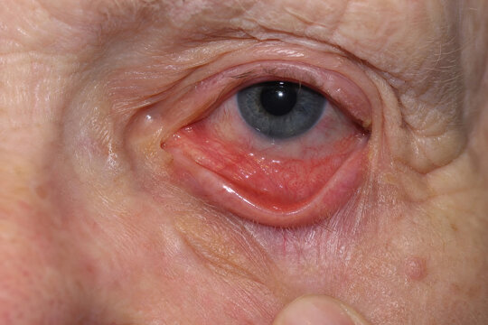 Age-Related Lower Eyelid Ectropion in Senior Patient Close Up