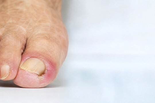Ingrown Toenail in Senior Patient Close Up During Clinical Foot Examination