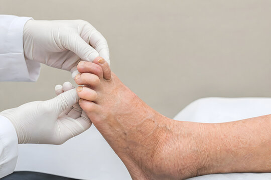 Healthcare Professional Examining Hammer Toe Deformity in Older Adult