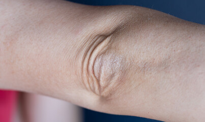 Fototapeta premium Close-up of dry wrinkled skin and hyperpigmentation on a human elbow joint