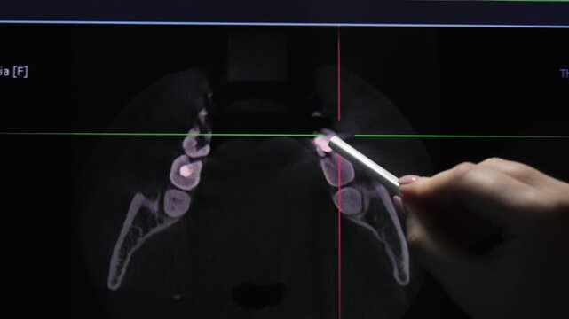 Close-up of a dentist pointing at a dental CBCT scan displayed on a computer monitor. Modern dental diagnostics, oral examination, treatment planning and digital dentistry concept. High quality 4k