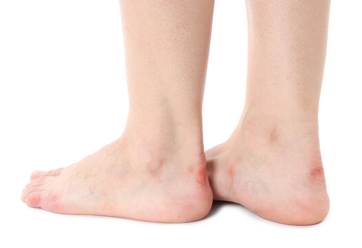 Woman with calluses on her feet against white background, closeup