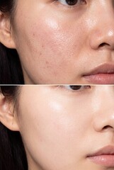 Naklejka premium Before and after comparison of acne scars enlarged pores and smoother facial skin treatment results