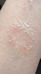 Fototapeta premium Close-up of Skin with Redness and Flaking Texture.