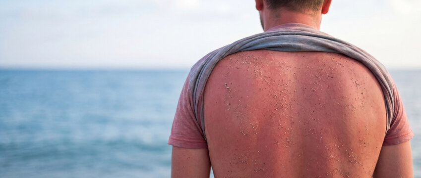 Sunburned man back covered in sand stands on a beach with red irritated skin from UV exposure, showing a painful sunburn on a sunny day for medical, travel, and skin care concepts
