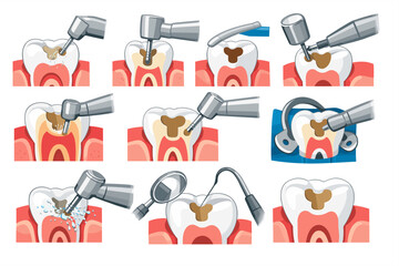 Naklejka premium Dental cavity preparation and filling process illustrated in multiple steps