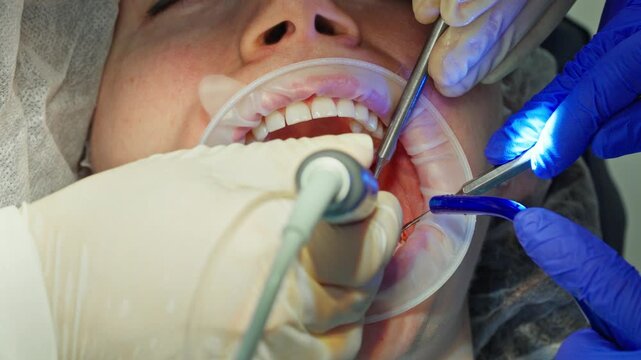  A close-up of dentists drilling a hole for a dental implant in the jaw of a young adult female patient with a dental drill, while draining excess saliva. Footage of a real-life surgical procedure