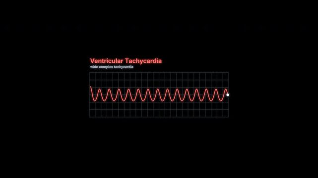 Ventricular Tachycardia ECG Rhythm Animation Labeled Heart Monitor Alpha 4K