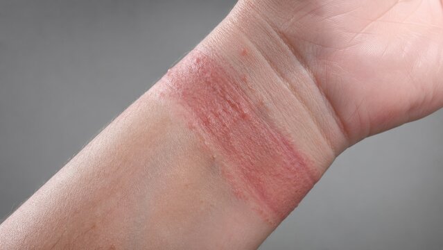 Contact dermatitis rash on wrist from watch strap