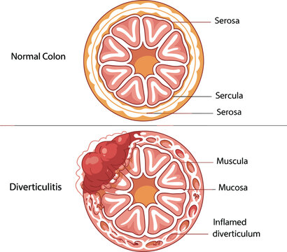 Normal Colon and Diverticulitis Comparison Medical Illustration with Labeled Intestinal Layers and Inflamed Diverticulum Anatomy for Healthcare Education