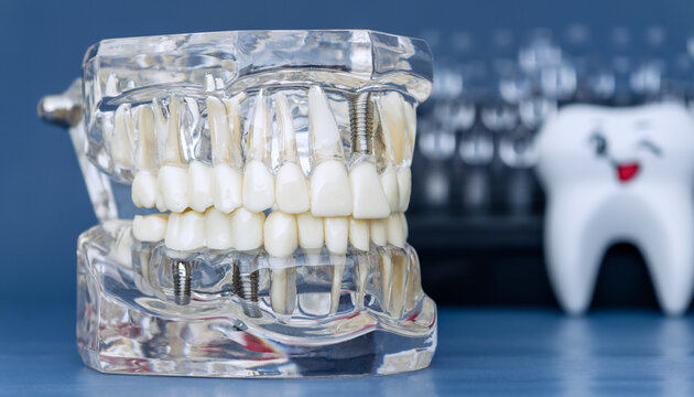 Transparent dental model with titanium implants and teeth roots. Modern dentistry and oral surgery concept.