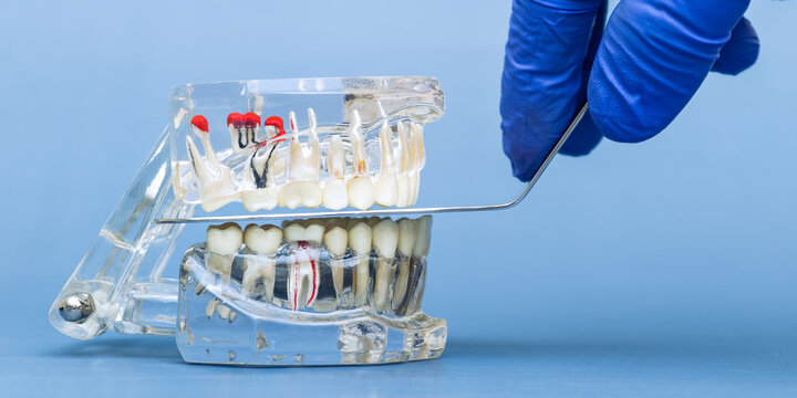 Dentist hand in blue glove using metal instrument on transparent anatomical jaw model to check bite occlusion on blue background.