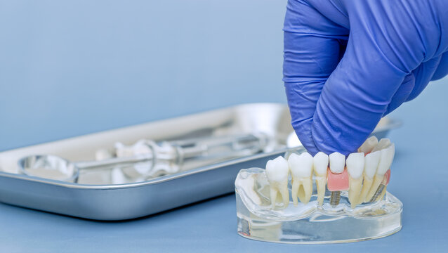 Dentist hand in blue glove demonstrating dental implant on transparent jaw model, oral surgery concept