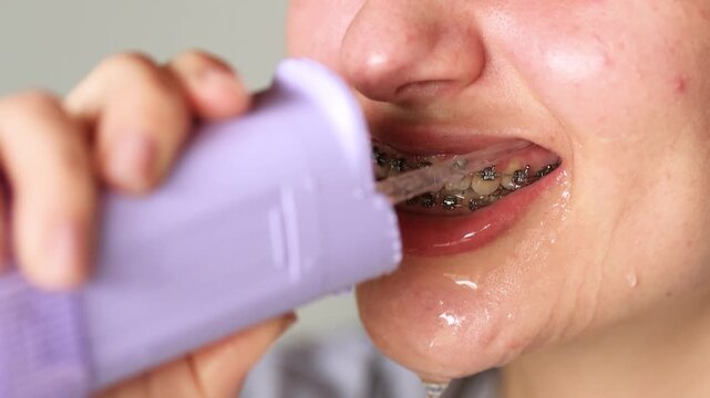 Slow motion close up video shows young woman with braces cleaning teeth using water flosser. Food washes from braces with splashes and flowing water. Proper oral hygiene routine.