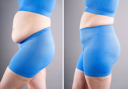 Before and after weight loss transformation, woman's fat body showing slimming results, liposuction, plastic surgery and tummy tuck