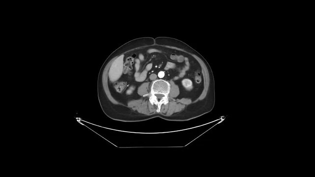 Contrast-Enhanced CT Abdomen and Pelvis, HV Phase, Axial 5 mm. Contrast-Enhanced CT Abdomen and Pelvis Hepatic Venous Phase Axial 5 mm DICOM Medical Imaging Anatomy Loop