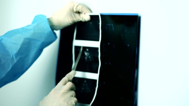 Analyzing MRI Scan Film. Doctor Holding Brain Magnetic Resonance Imaging Results. Planning Neurosurgery Procedure 