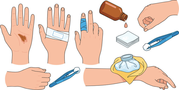 Medical First Aid and Skin Burn Care Vector Illustration Set with Scabbed Hand Liquid Antiseptic Plasters Gauze Tweezers and Cold Ice Compress