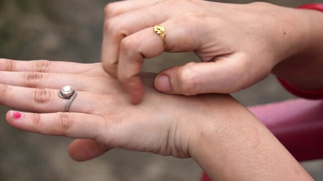 Women Hand Itching After Mosquito Bite.