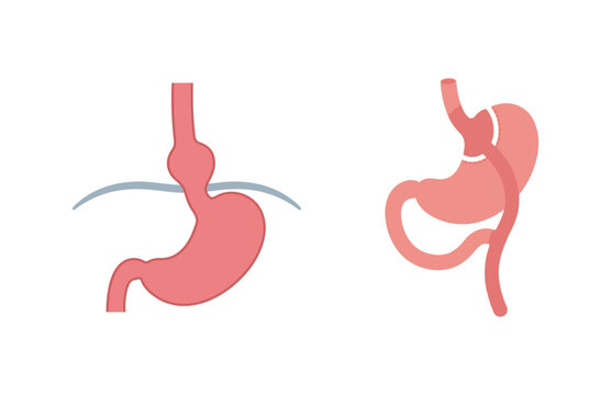 Illustration of Hiatal Hernia and Gastric Bypass Surgery Procedure Comparison