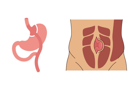 Medical Illustration of Gastric Bypass Surgery Procedure and Abdominal Incision Site for Weight Loss Concept