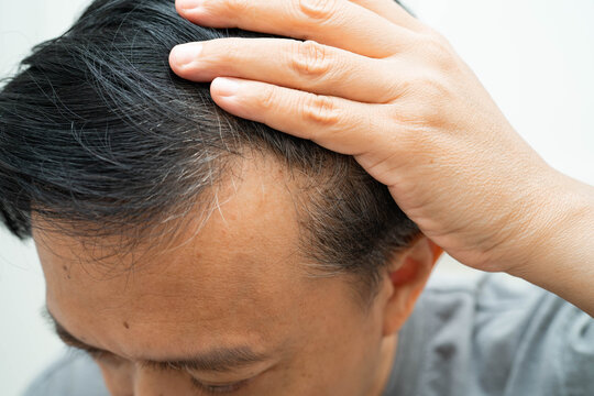 Bald head in man, hair loss treatment health problem.