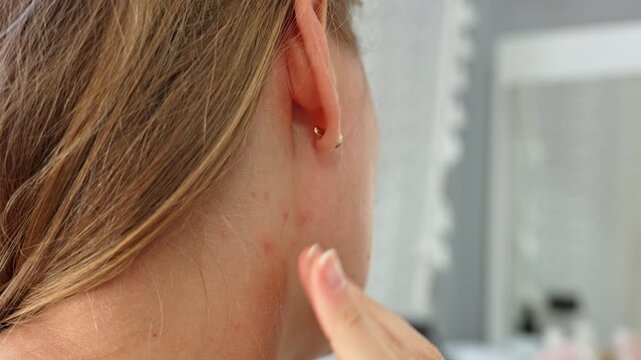 Close-up of a young woman's neck with red pimples and blemishes, as she gently applies a therapeutic cream with her fingers to treat problematic skin in a bathroom setting