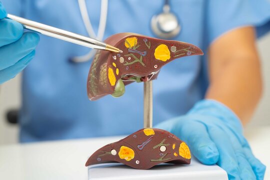 Cirrhosis, Liver cancer, fatty liver, Asian doctor with liver human anatomy model in World Hepatitis Day at hospital.