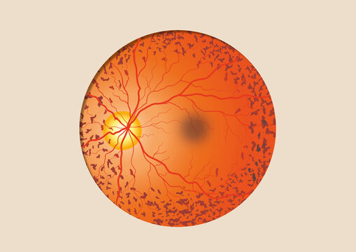 Retina pigmentosa, illustration
