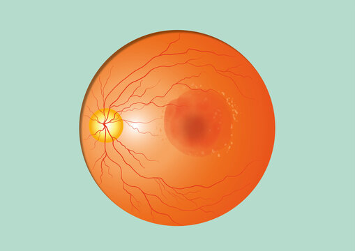 Wet macular degeneration, illustration