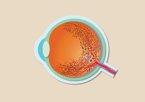 Retina pigmentosa, illustration