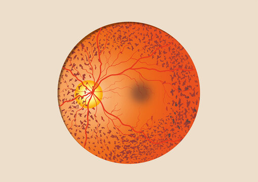 Retina pigmentosa, illustration