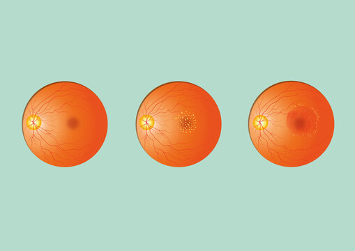 Macular degeneration, illustration