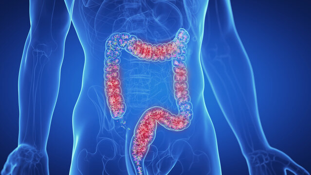 Illustration of the microbiota of an inflamed colon