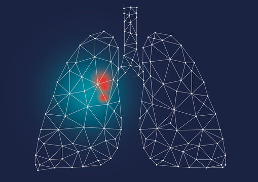 Lung cancer, conceptual illustration