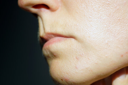 Close-up of lower female face with mild blemishes and skin texture under directional light. Highlights adult breakout-prone skin, realistic cosmetic photography, and non-retouched complexion details.