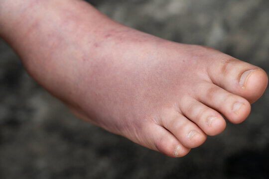 Swollen Foot After Cast Removal of Metatarsal Fracture