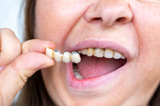 woman holding detached dental bridge next open mouth, decayed damaged teeth underneath, neglected oral hygiene, delayed checkups, broken crown prosthesis failure, need urgent prosthodontics treatment