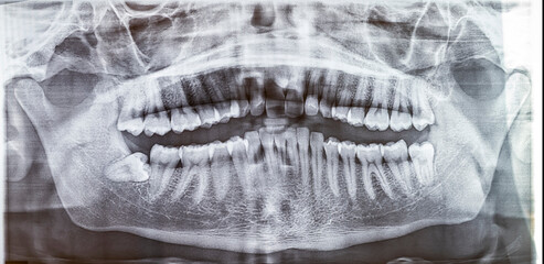 A wide panoramic dental radiograph (OPG) displays a full set of 32 teeth, revealing a horizontally impacted lower wisdom tooth. The bony trabecular pattern and both temporomandibular joints (TMJ). © MSC