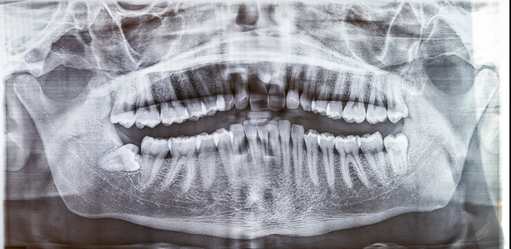 A wide panoramic dental radiograph (OPG) displays a full set of 32 teeth, revealing a horizontally impacted lower wisdom tooth. The bony trabecular pattern and both temporomandibular joints (TMJ).