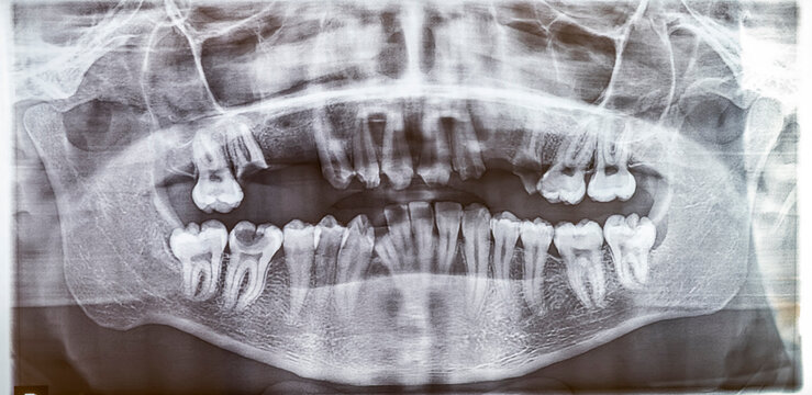 A panoramic dental radiograph of an adult patient with two missing maxillary molars and multiple decayed molars. The anterior maxillary teeth are prepared as abutments for a fixed prosthesis denture.