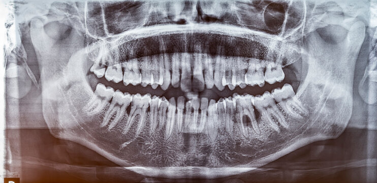 A wide panoramic dental radiograph (OPG) displays a full set of 32 teeth, revealing periodontitis  disease with significant horizontal and vertical bone loss localized around the lower molars.