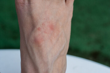 Fototapeta premium Detailed macro shot of a dermatological issue showing red spotty rash on the skin surface of a foot.