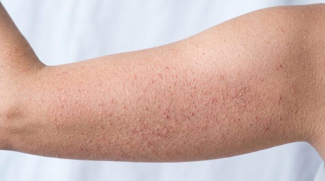 Upper arm with keratosis pilaris showing rough follicular papules chicken skin texture with redness, common benign skin condition dermatology concept