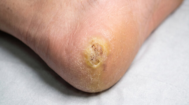 Foot sole with plantar wart showing flat rough hyperkeratotic lesion with black pinpoint dots on heel, HPV verruca plantaris dermatology concept