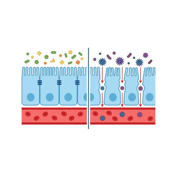 Diagram Showing Intestinal Barrier Function With Healthy Gut Lining Versus Increased Permeability Leading To Leaky Gut